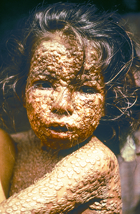 bambina con vaiolo (Bangladesh)